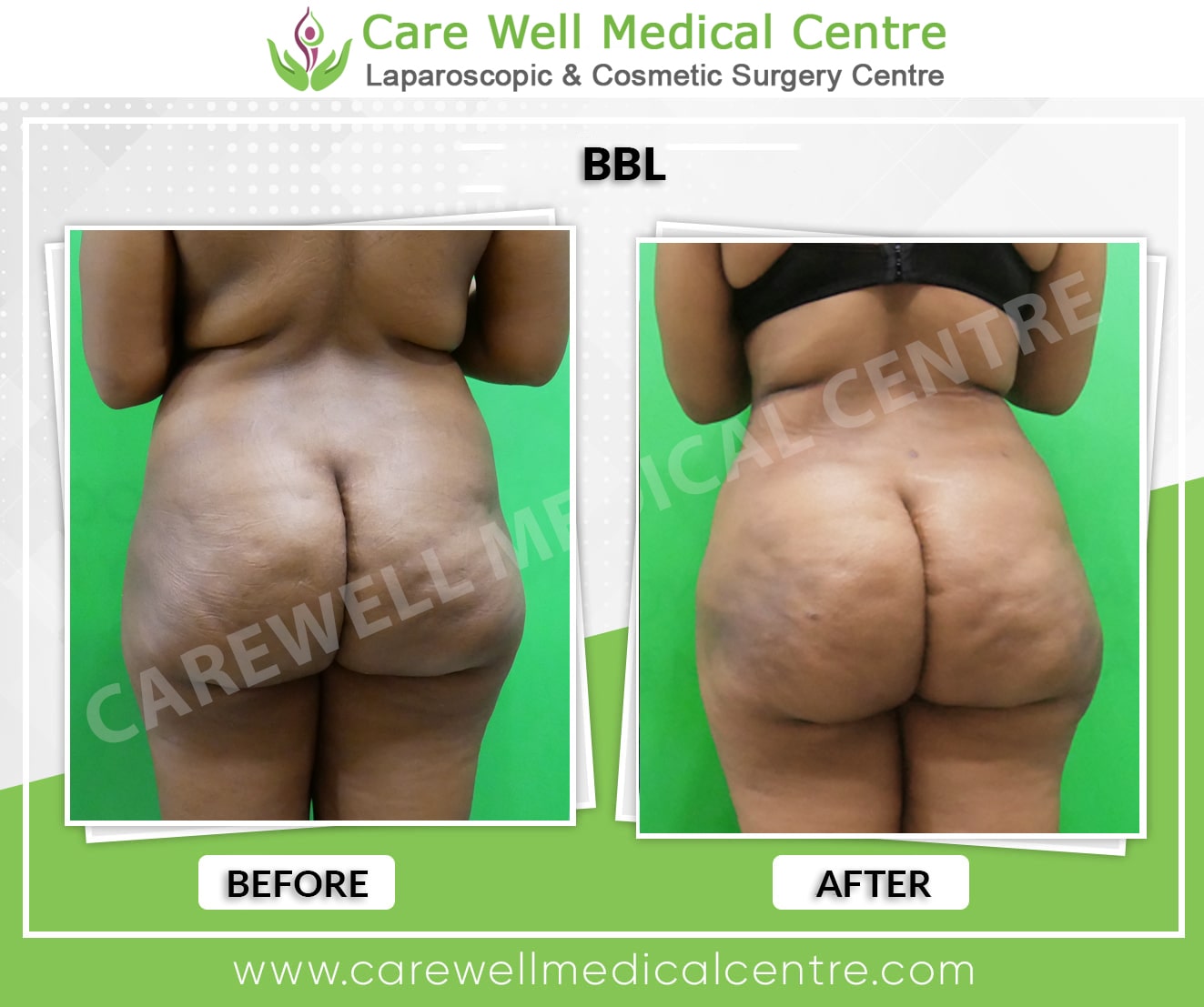 bbl surgery before and after result