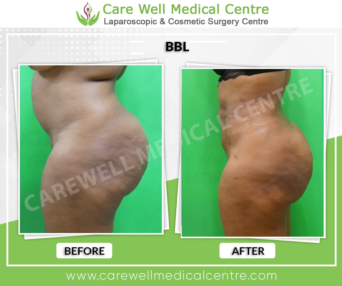 bbl surgery before and after result