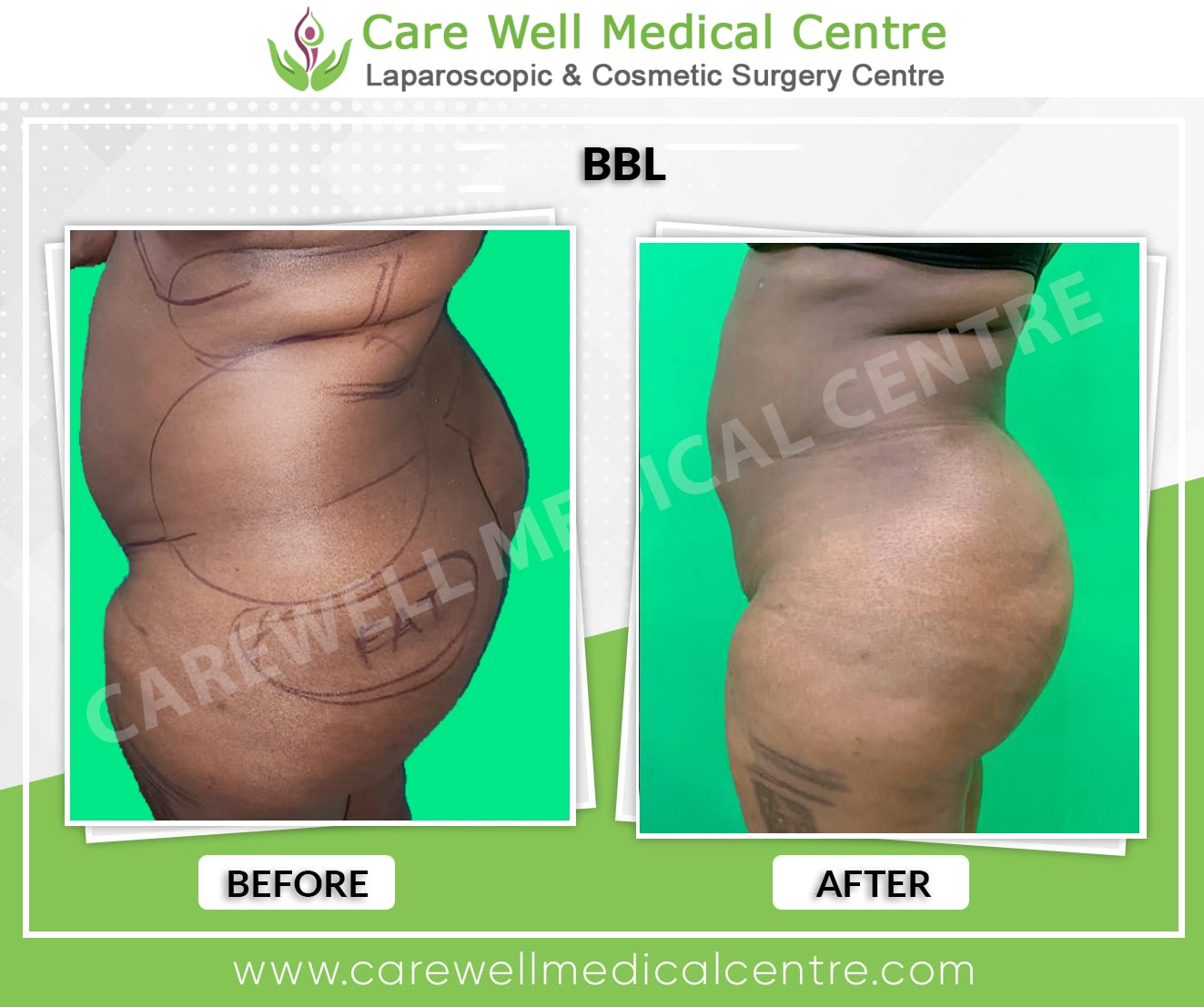 bbl surgery before and after result