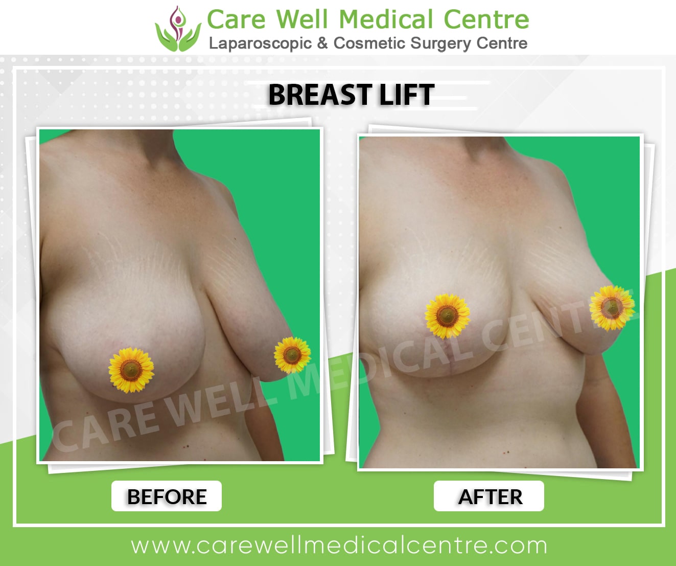 breast lift before and after result in Delhi