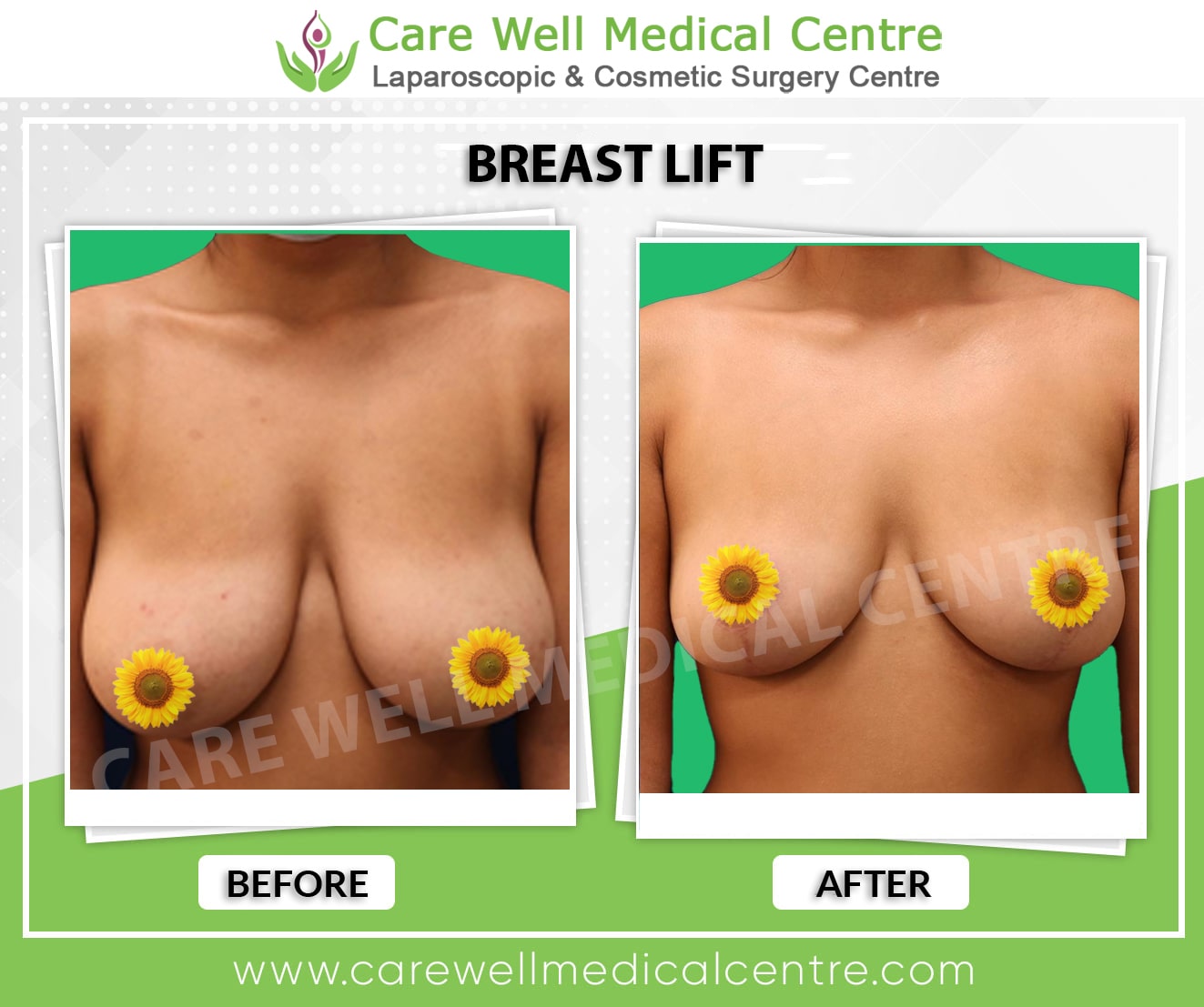 breast lift before and after results in Delhi