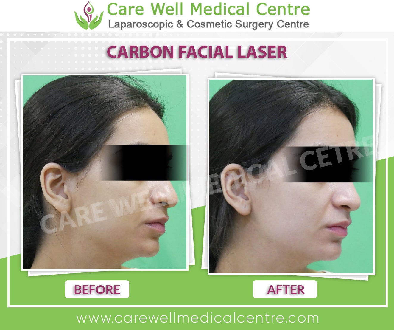 carbon laser facial teratment before and after result