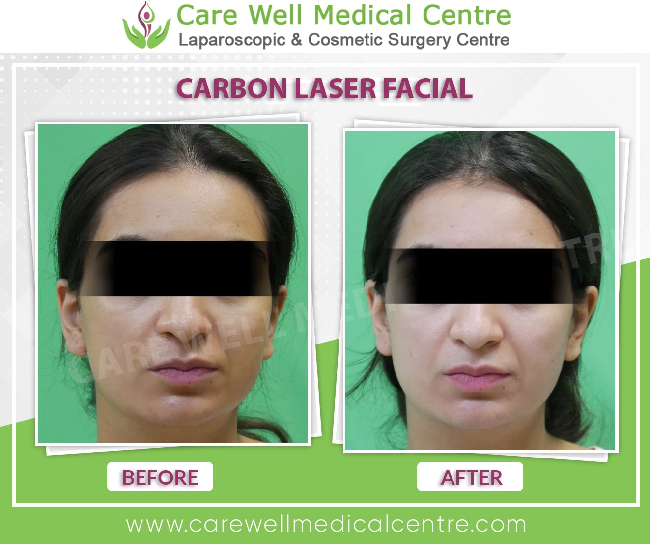 carbon laser facial teratment before and after