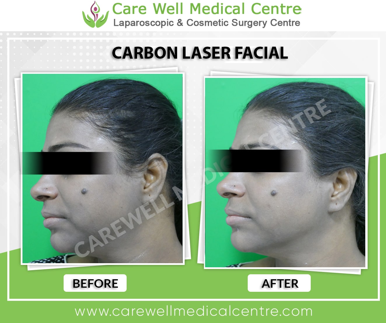 carbon laser facial treatment before and after results