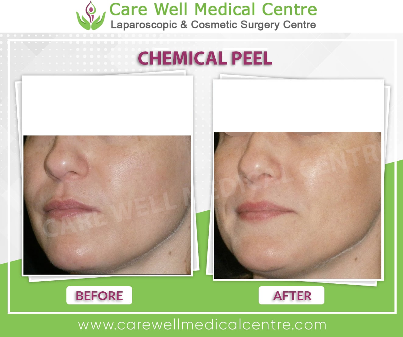 chemical peel before and after photo