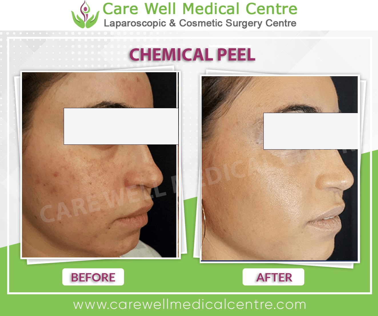 chemical peel before and after result