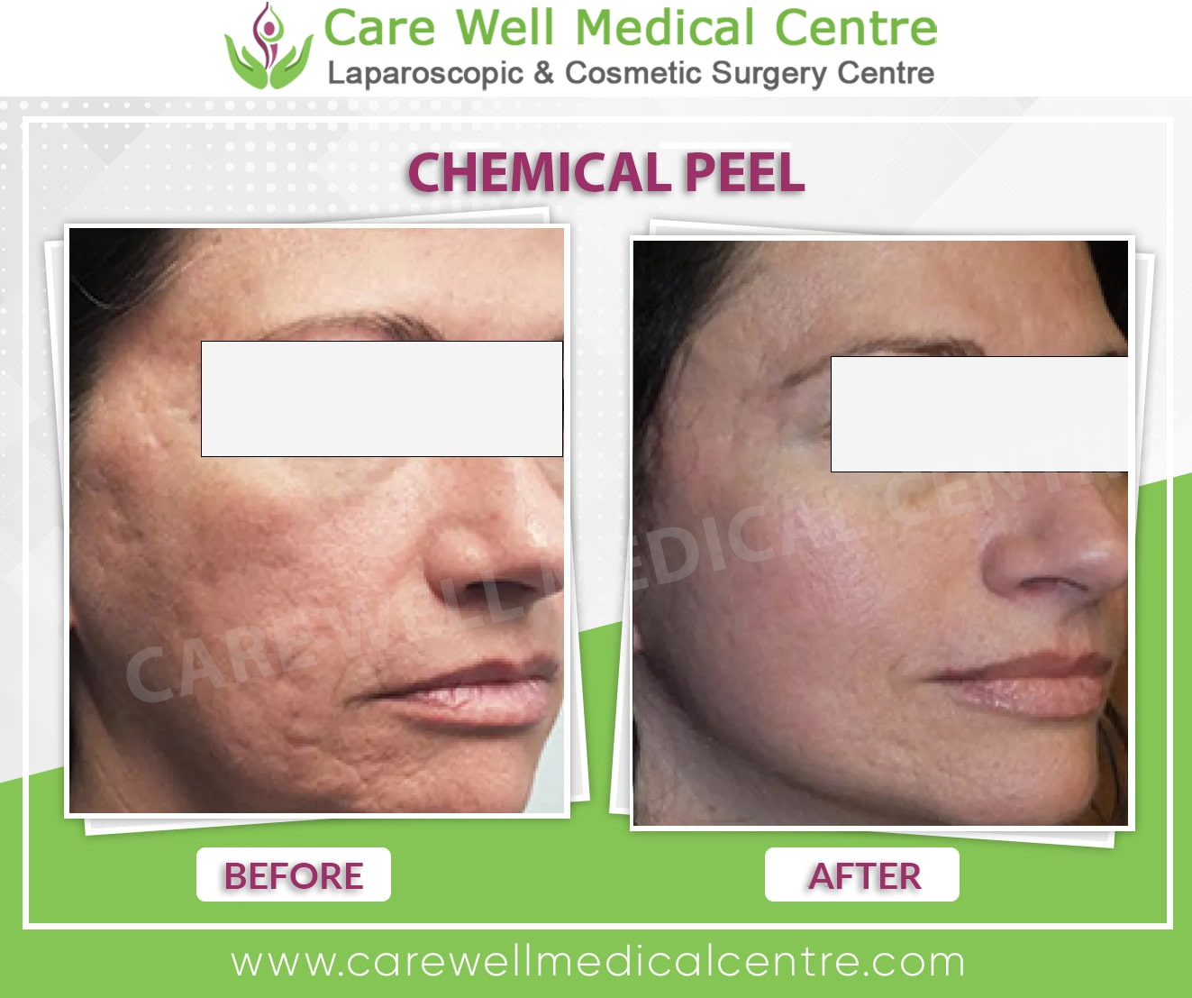 chemical peel before and after results