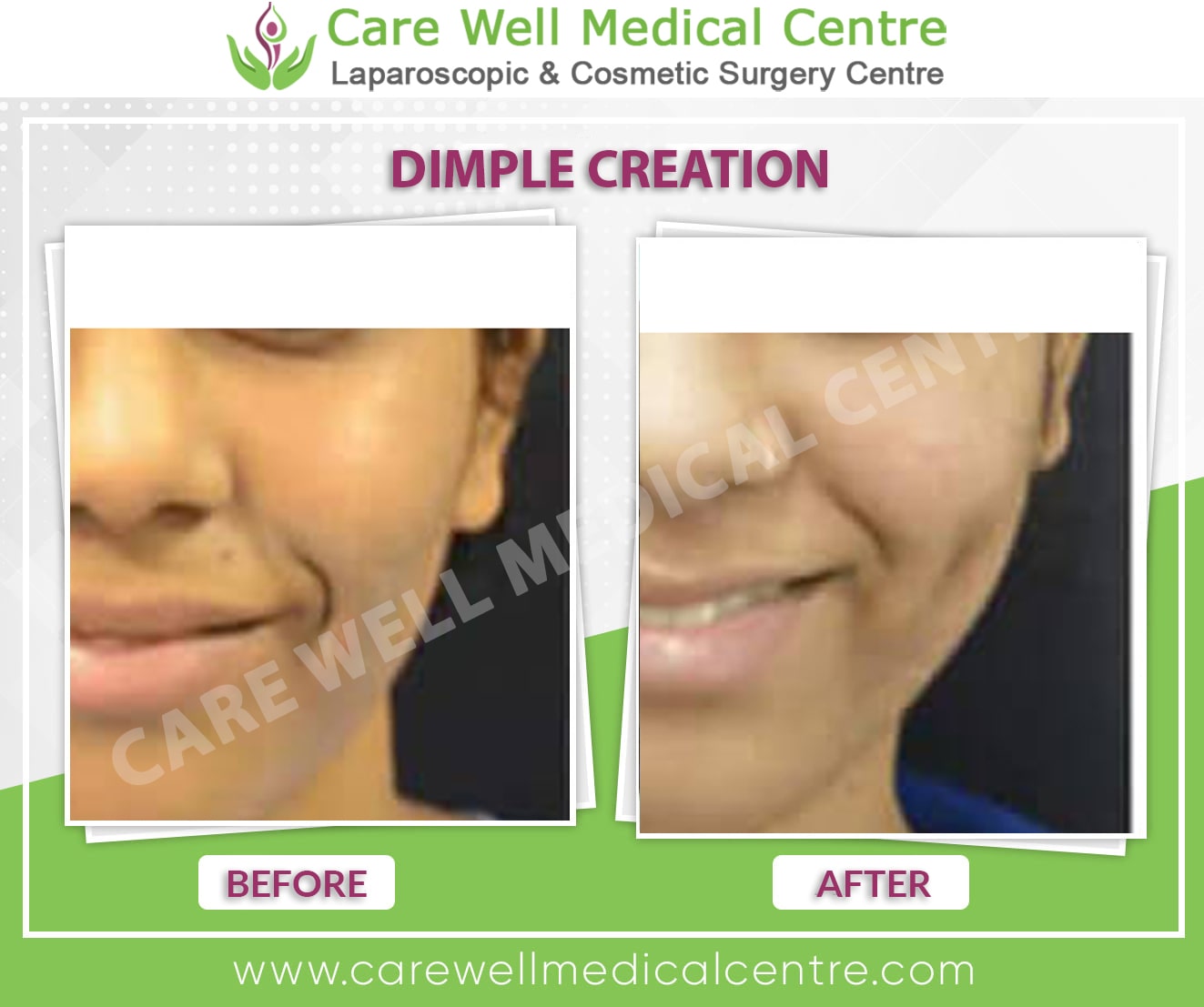 dimple creation before and after photo