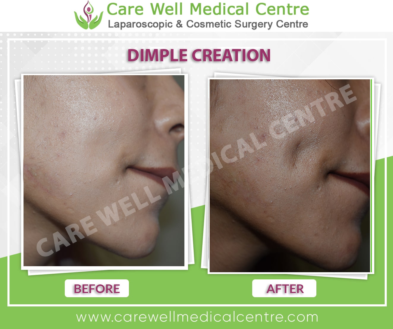 dimple creation before and after result