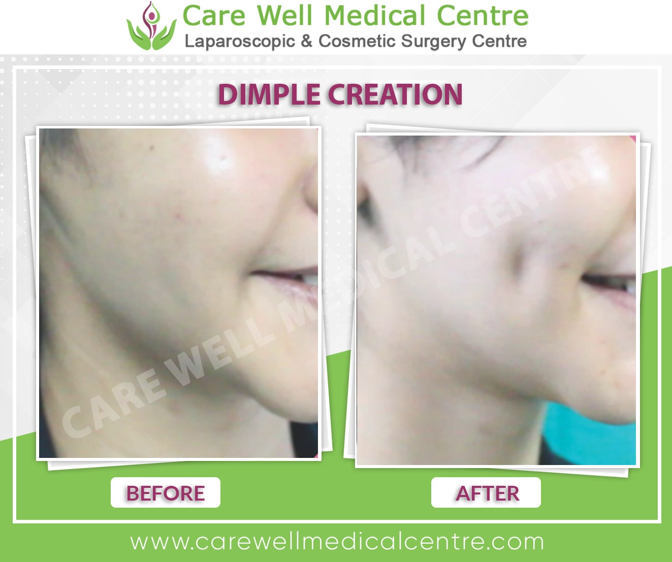 dimple creation before and after results