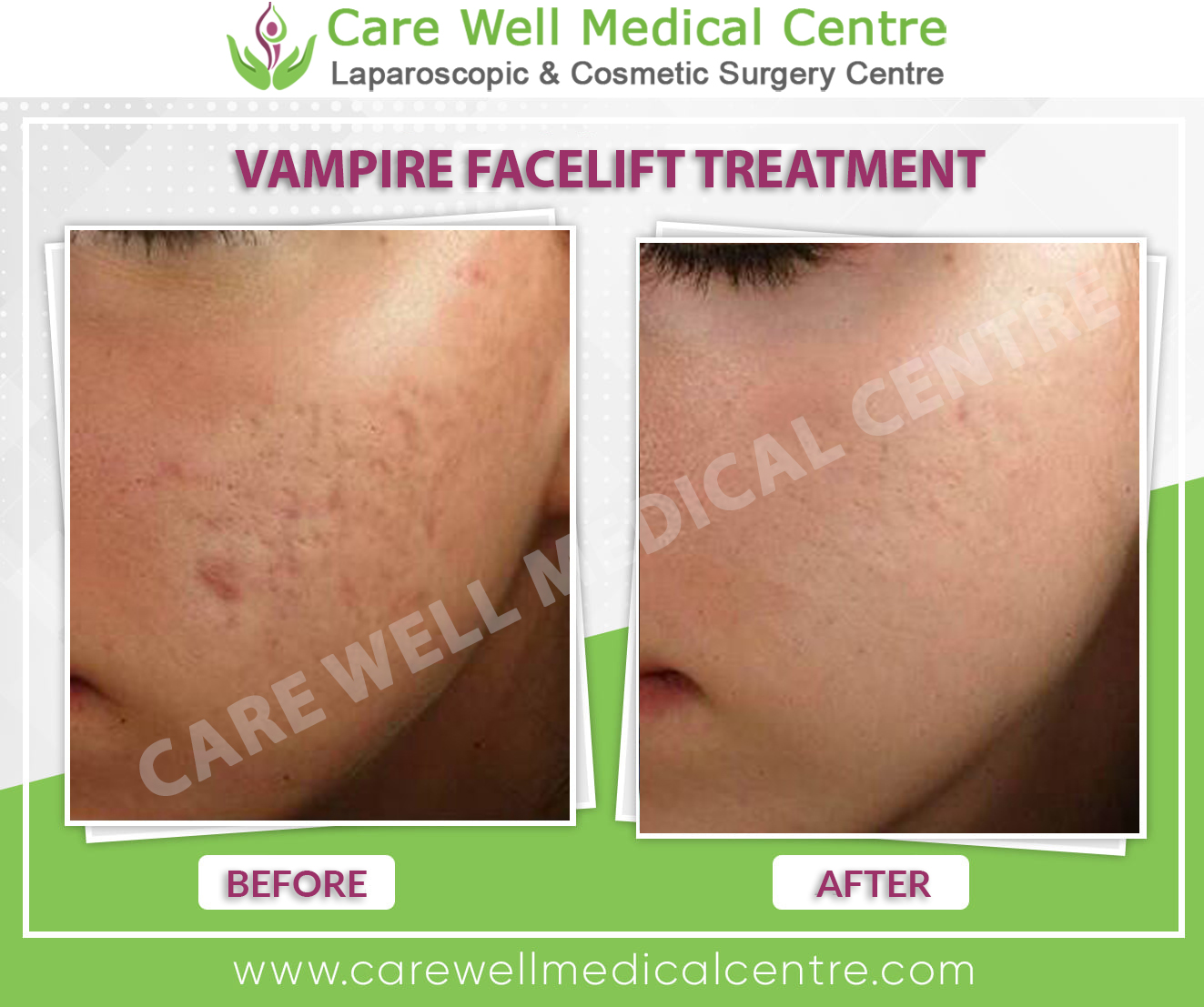 vampire facelift before and after photo