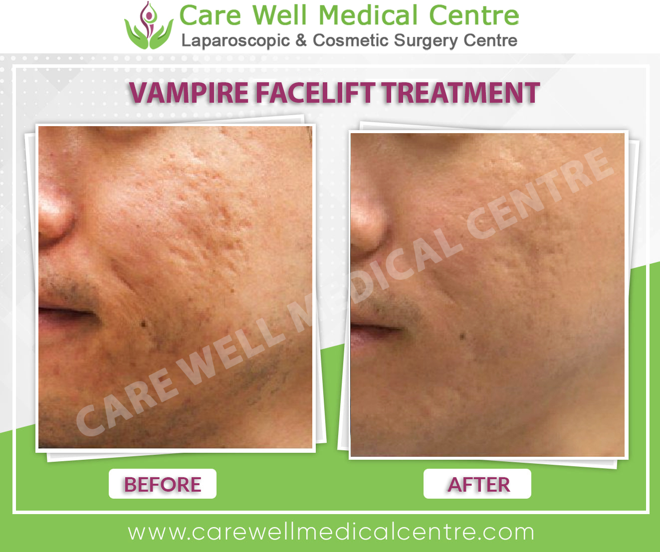 vampire facelift before and after result