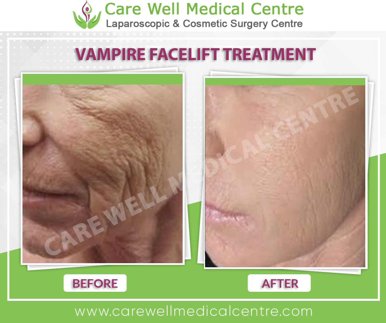 vampire facelift before and after result