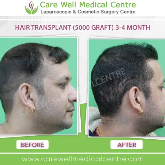 Hair transplant photos month by month showing before and after results in Delhi.