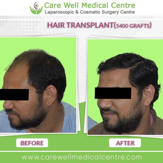 5000 Graft hair Transplant Before and after results photo