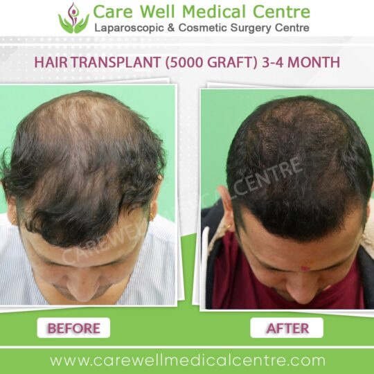 Hair transplant photos month by month