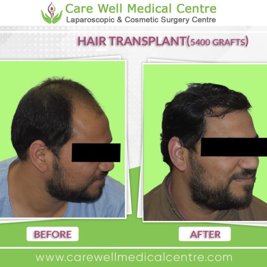 5000 Graft hair Transplant Before and after results photo