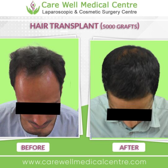 5000 Graft hair Transplant Before and after results photo