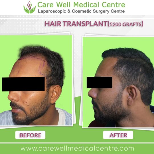 5000 Graft hair Transplant Before and after results photo