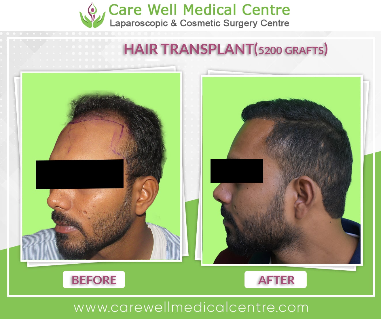Hair Transplant Before And After Photos Care Well Medical Centre