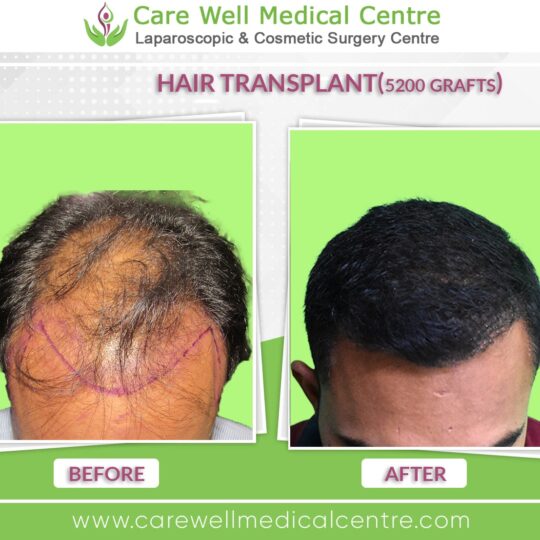 5000 Graft hair Transplant Before and after results photo