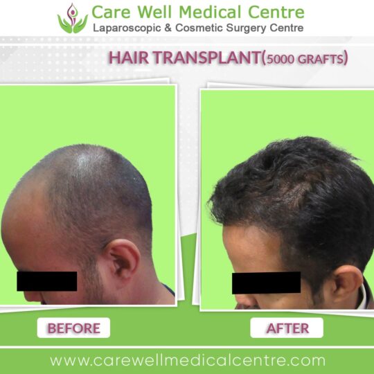 5000 Graft hair Transplant Before and after results photo