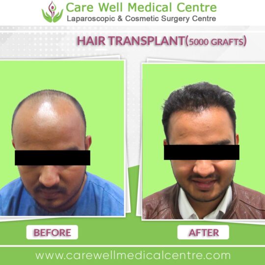 5000 Graft hair Transplant Before and after results photo