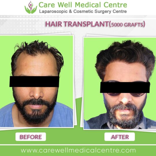 5000 Graft hair Transplant Before and after results photo