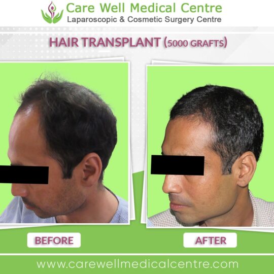 5000 Graft hair Transplant Before and after results photo