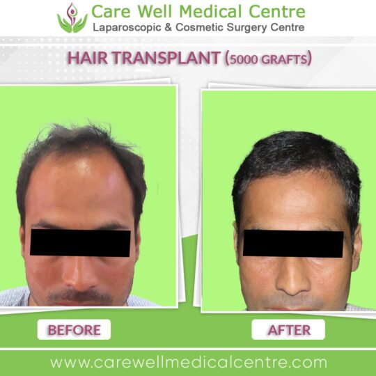 5000 Graft hair Transplant Before and after results photo