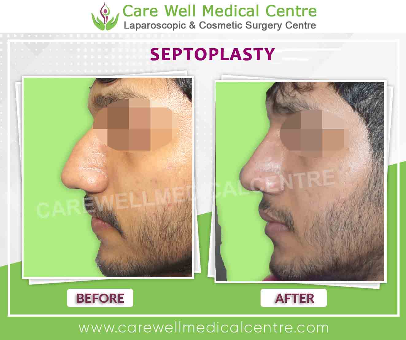 Septoplasty Surgery before and after result in delhi