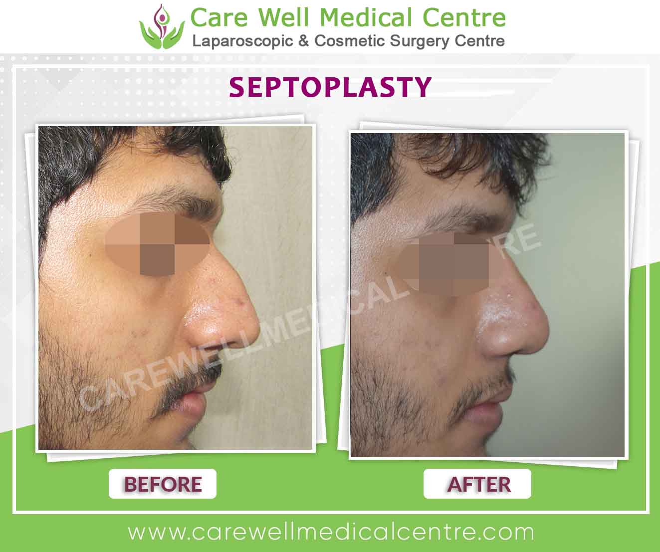 Septoplasty Surgery before and after in delhi