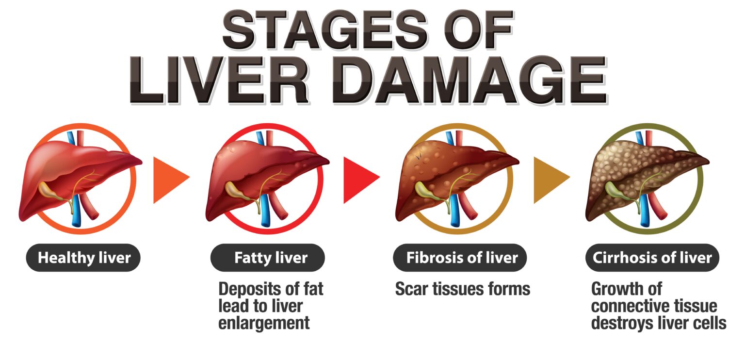 Fatty Liver A Guide To Prevention And Treatment Care Well Medical Centre