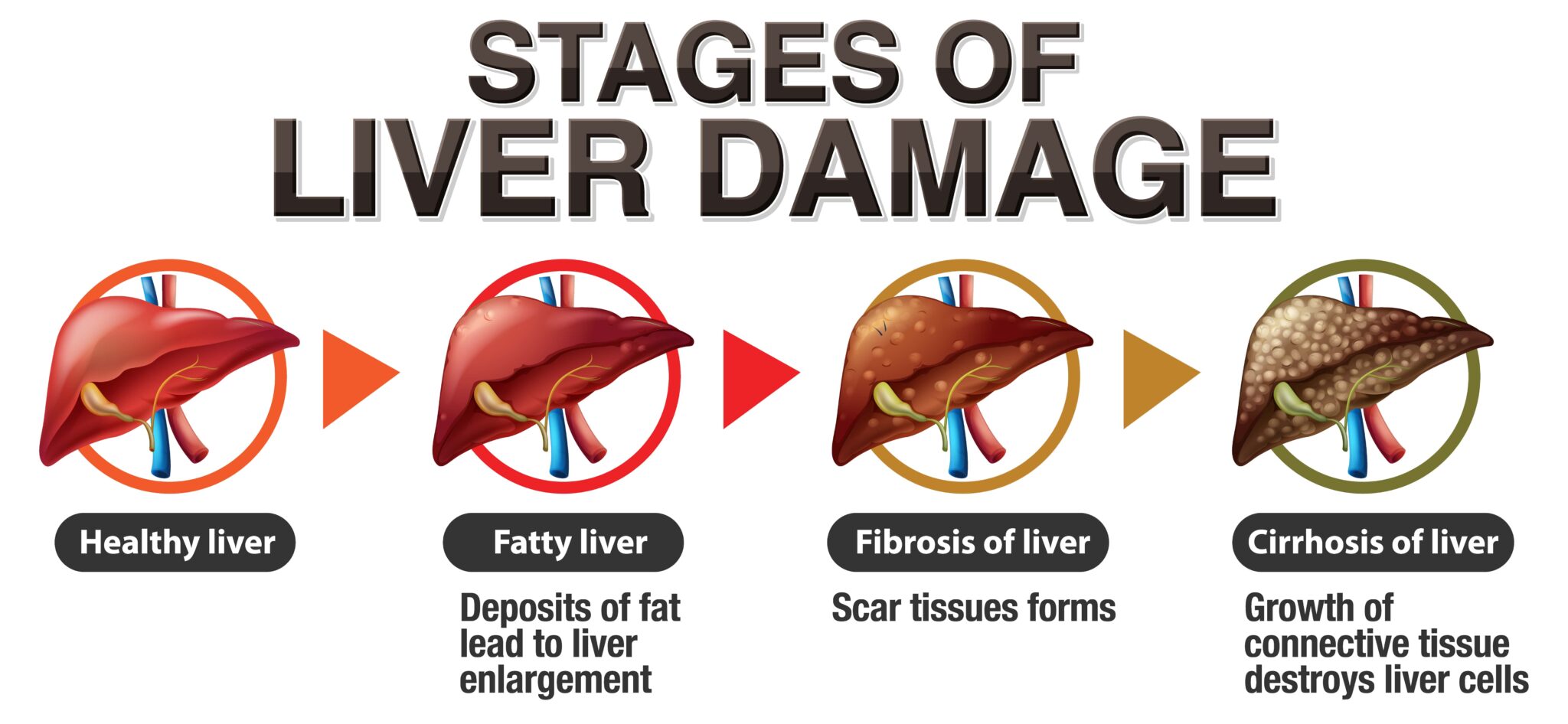 Fatty Liver: A Guide to Prevention and Treatment | Care Well Medical Centre