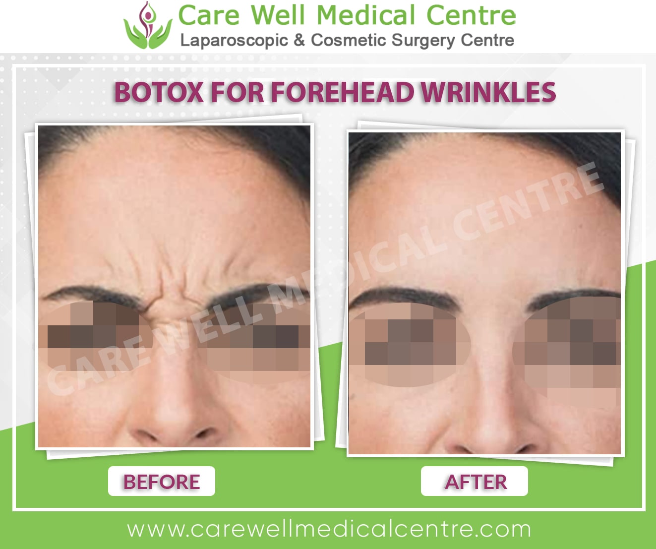 botox for forehead lines before and after result in Delhi