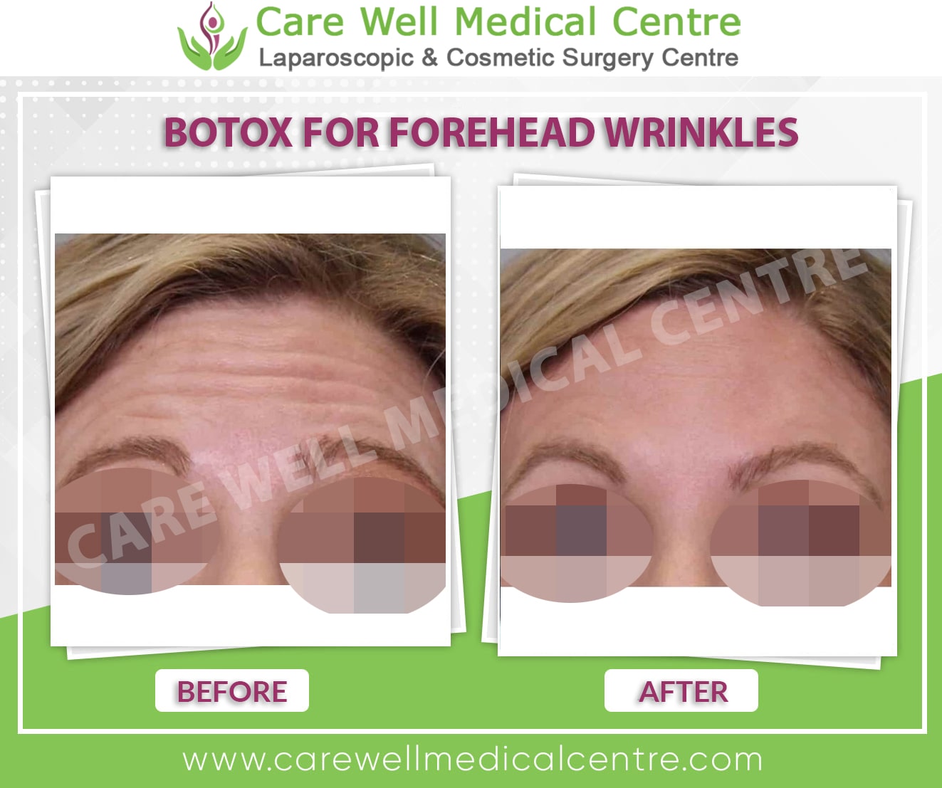 botox for forehead lines before and after result in India