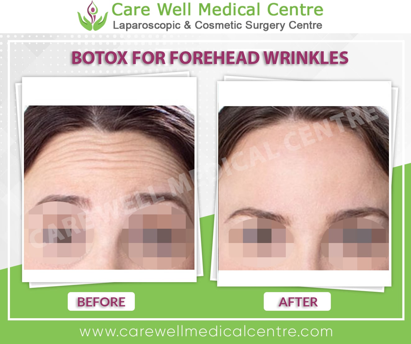 botox for forehead lines before and after results