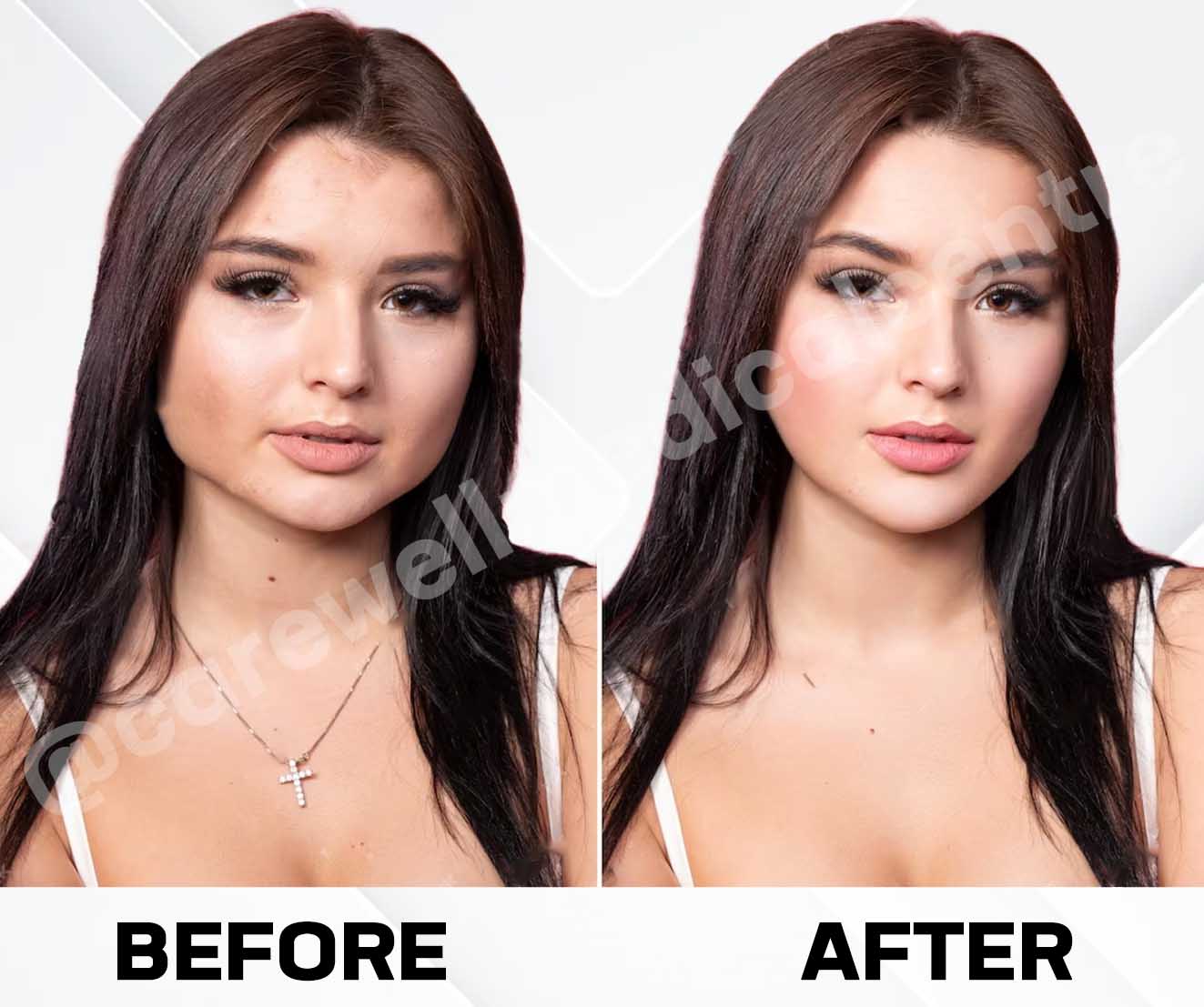 Face Slimming Treatment Before and after results photo