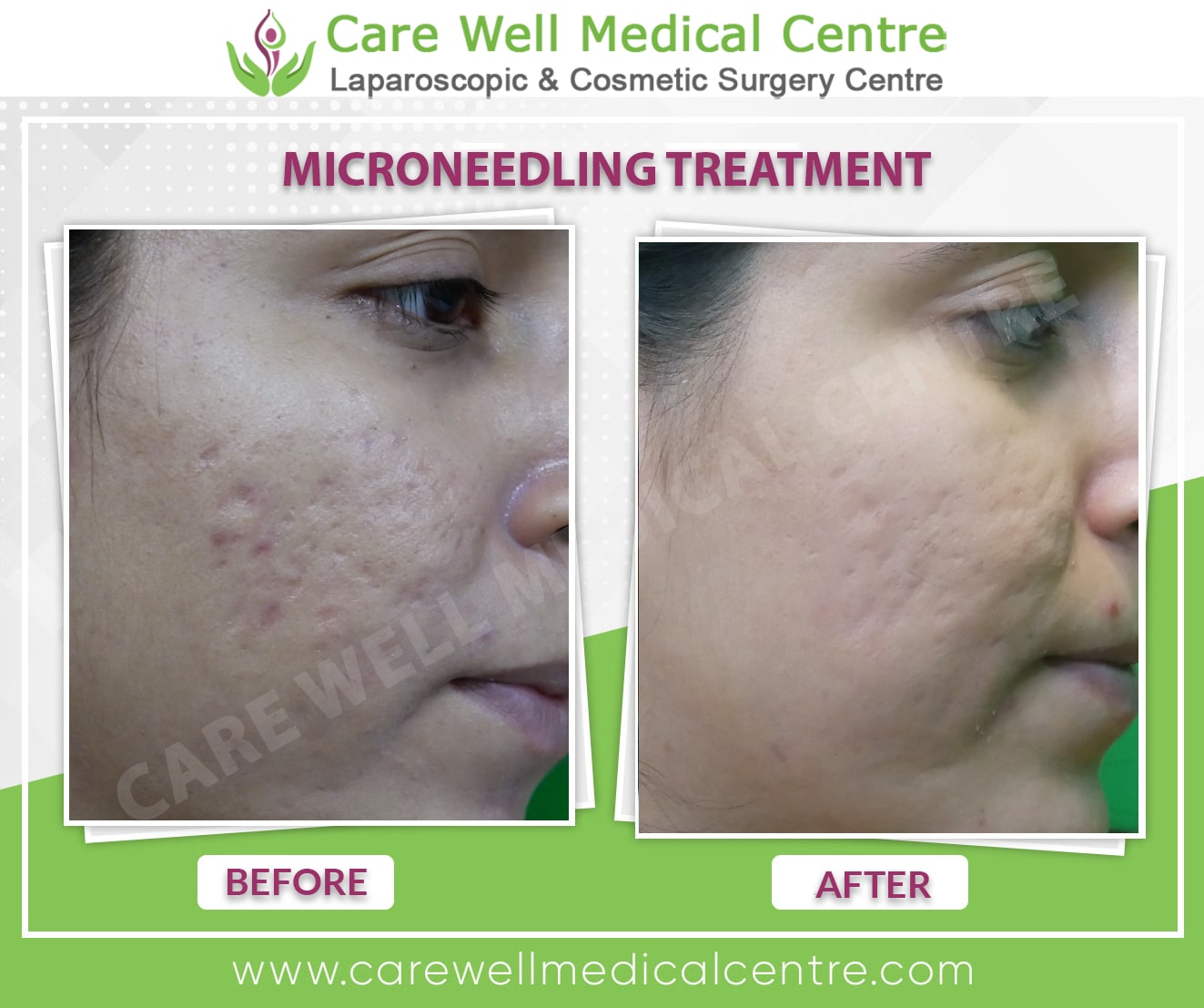 Microneedling treatment before and after result