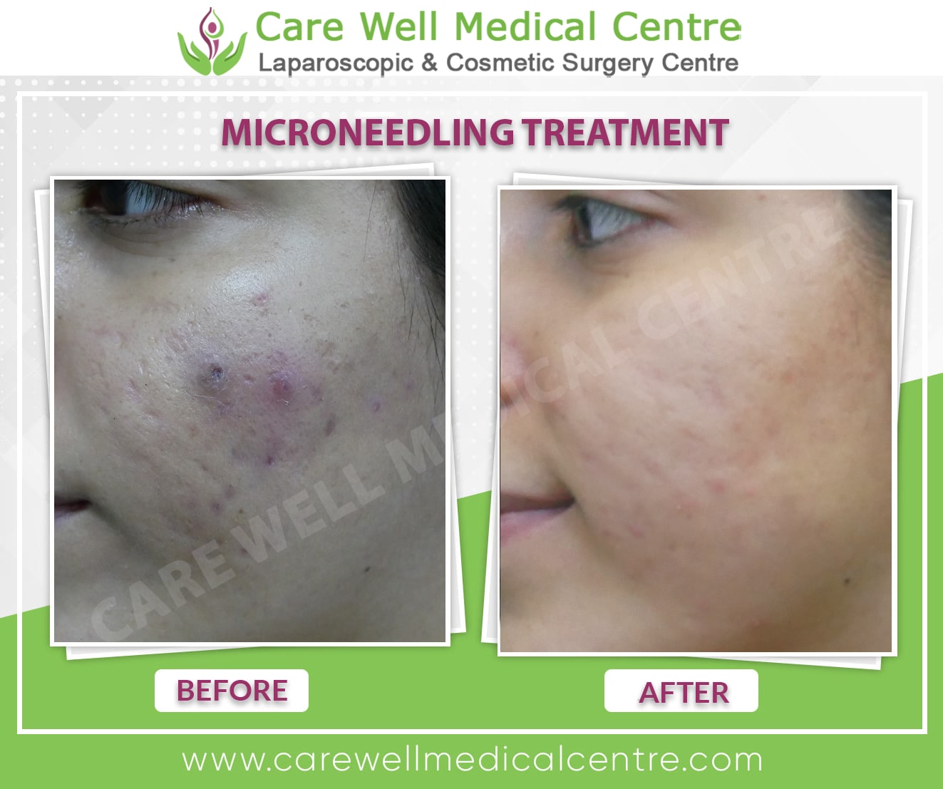 Microneedling treatment in Delhi before and after Results