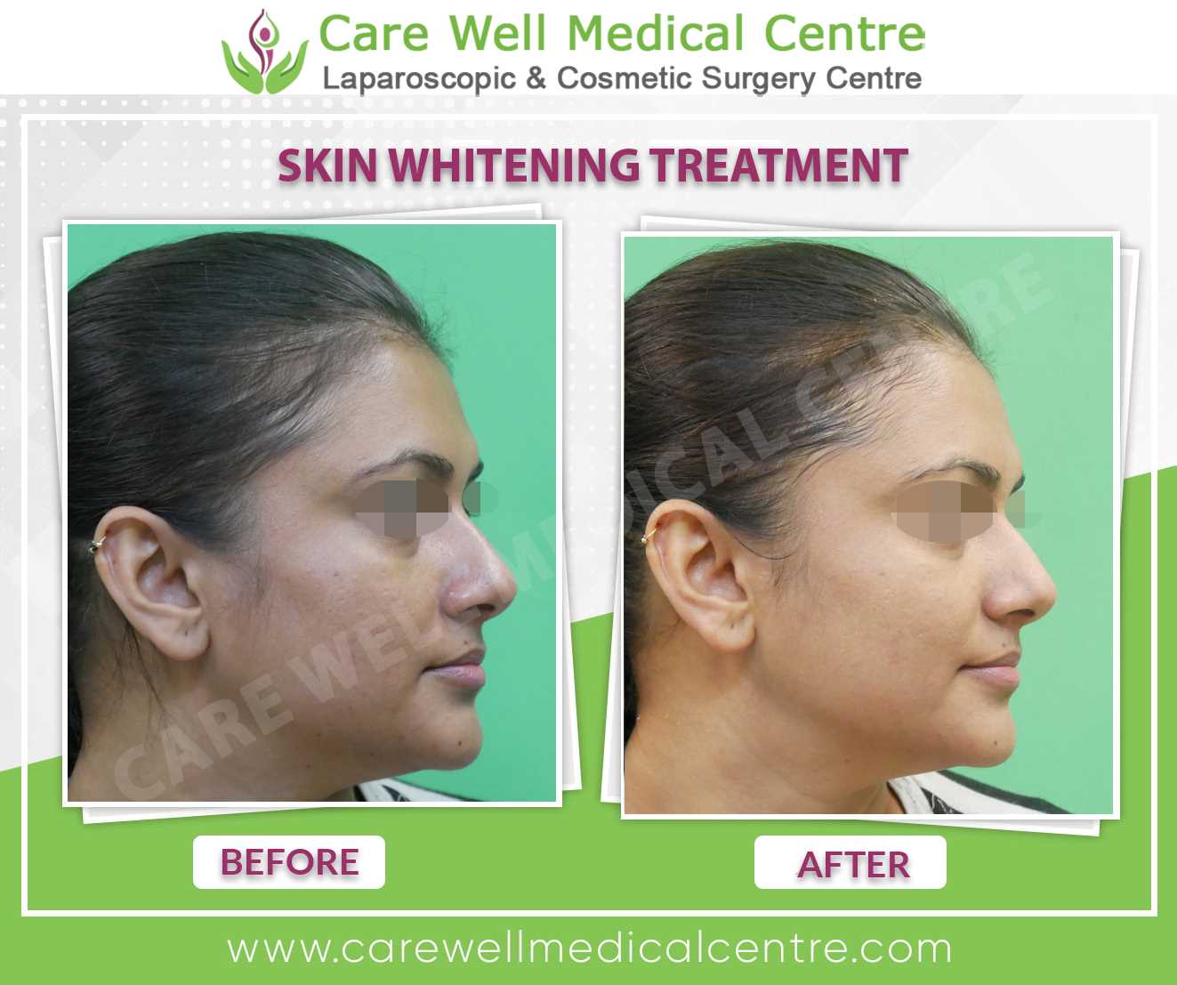 Skin Whitening Treatment Before and after result photo