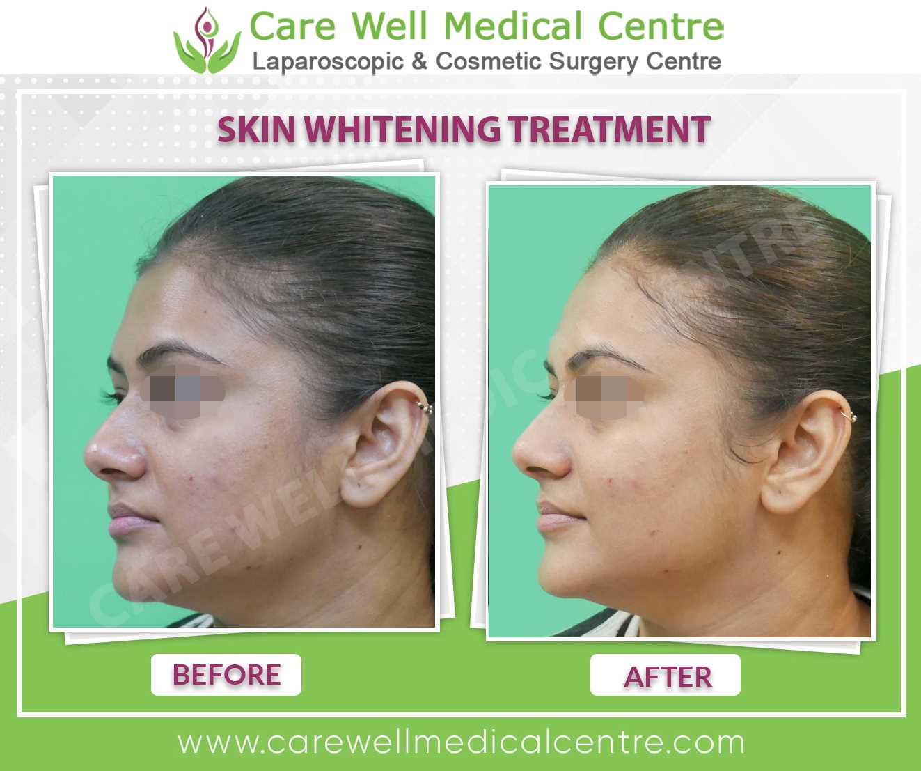 Skin Whitening Treatment Before and after result image