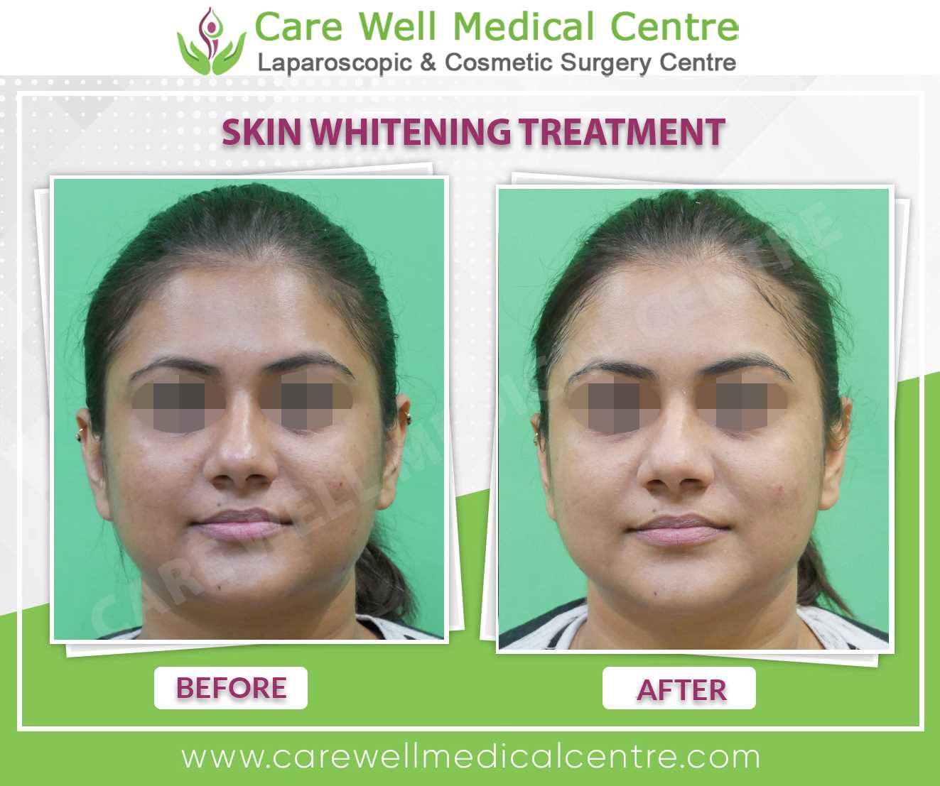 Skin Whitening Treatment Before and after result