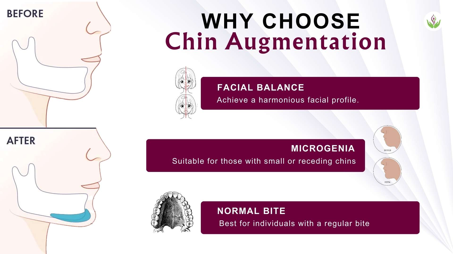 Why Choose Chin Augmentation