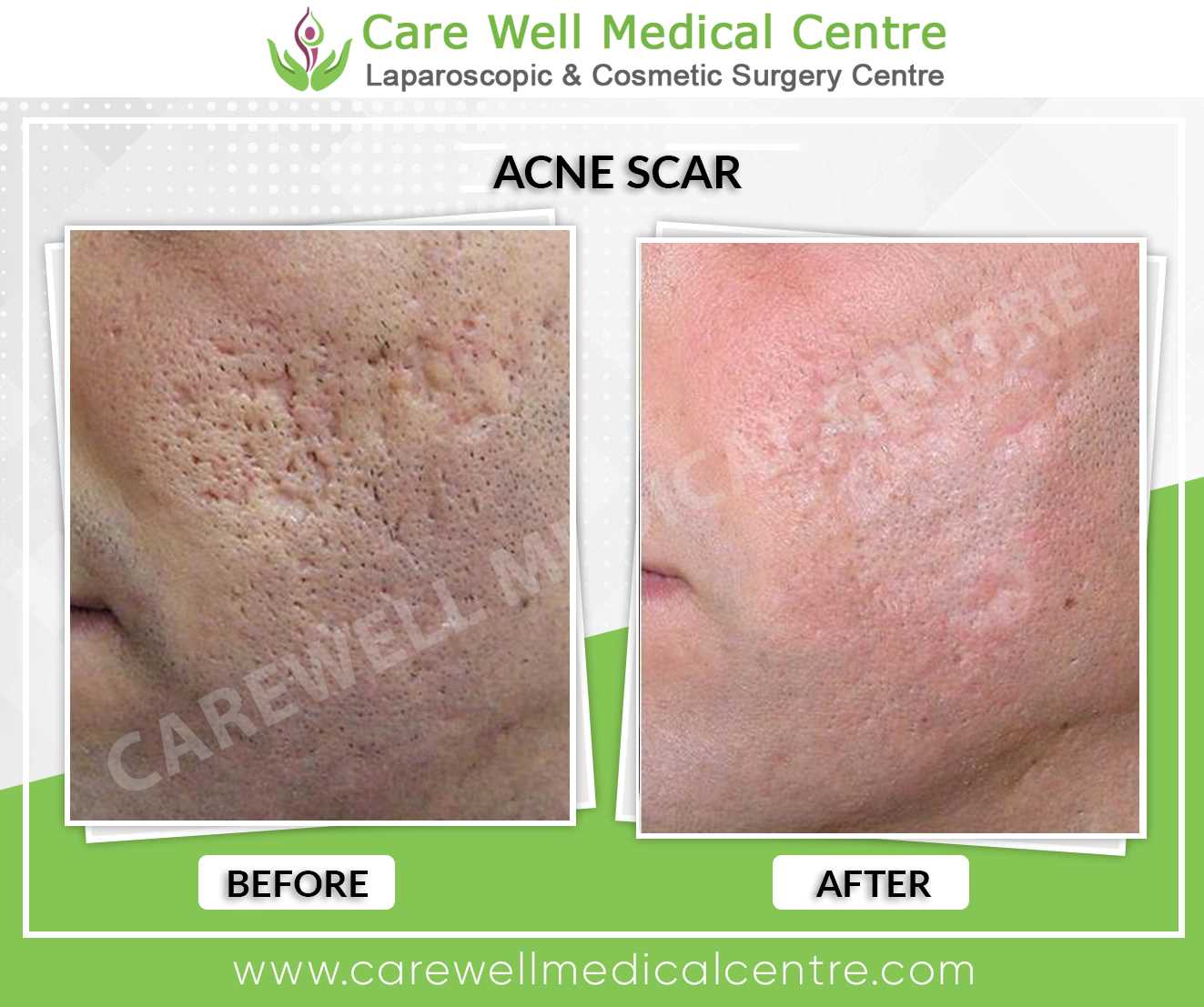 Before and After Results of Acne Scar Treatment in Delhi