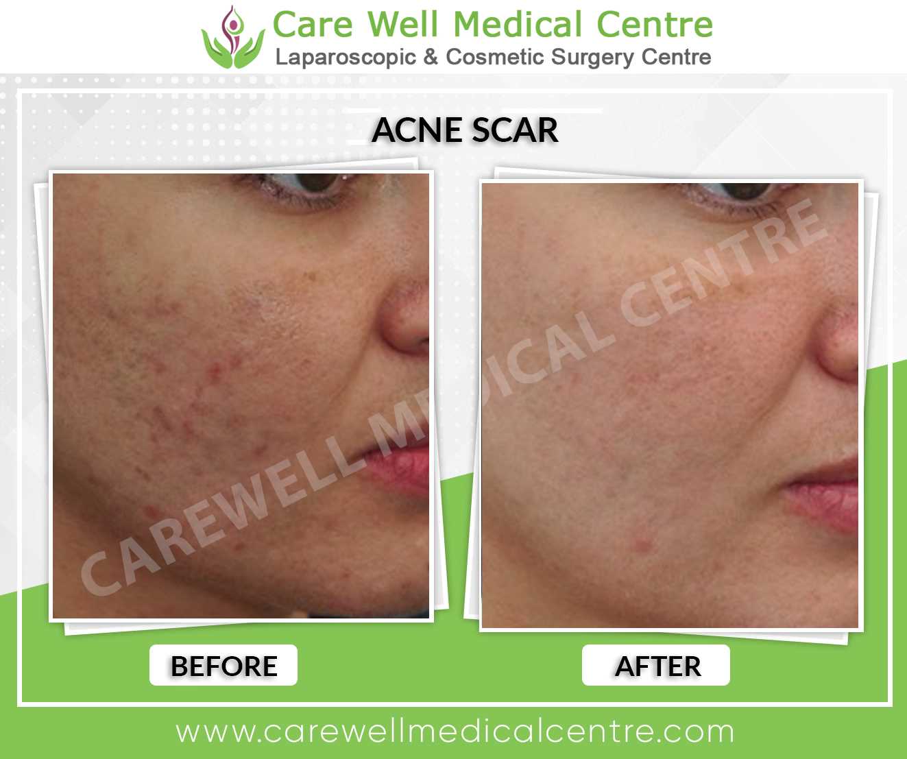 Acne Scar Treatment Before and After Results in Delhi