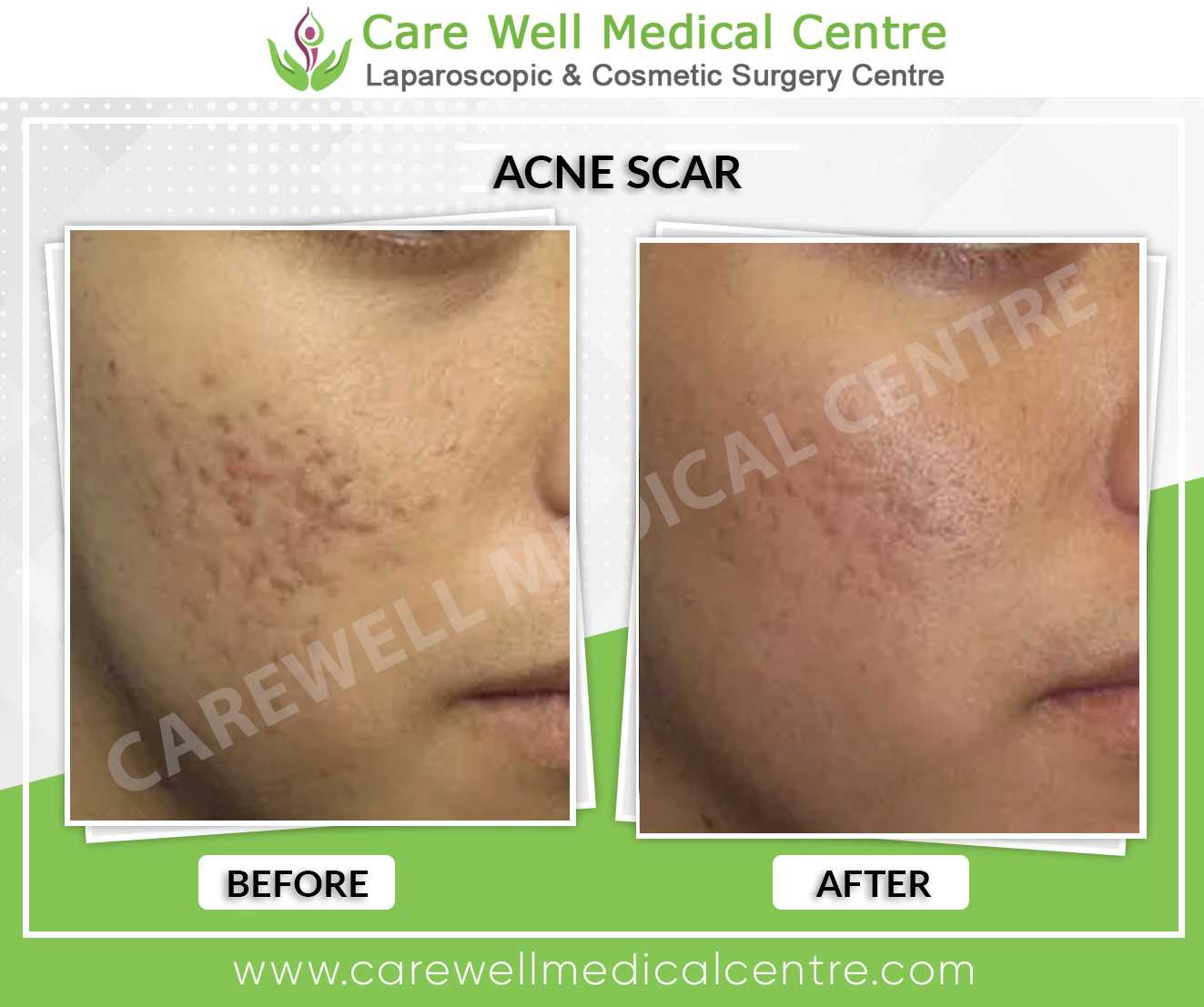 Before and After Photo of Acne Scar Treatment in Delhi