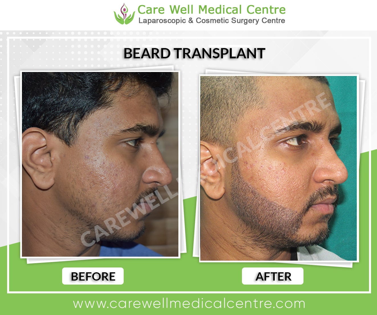 Beard Transplant before and after result