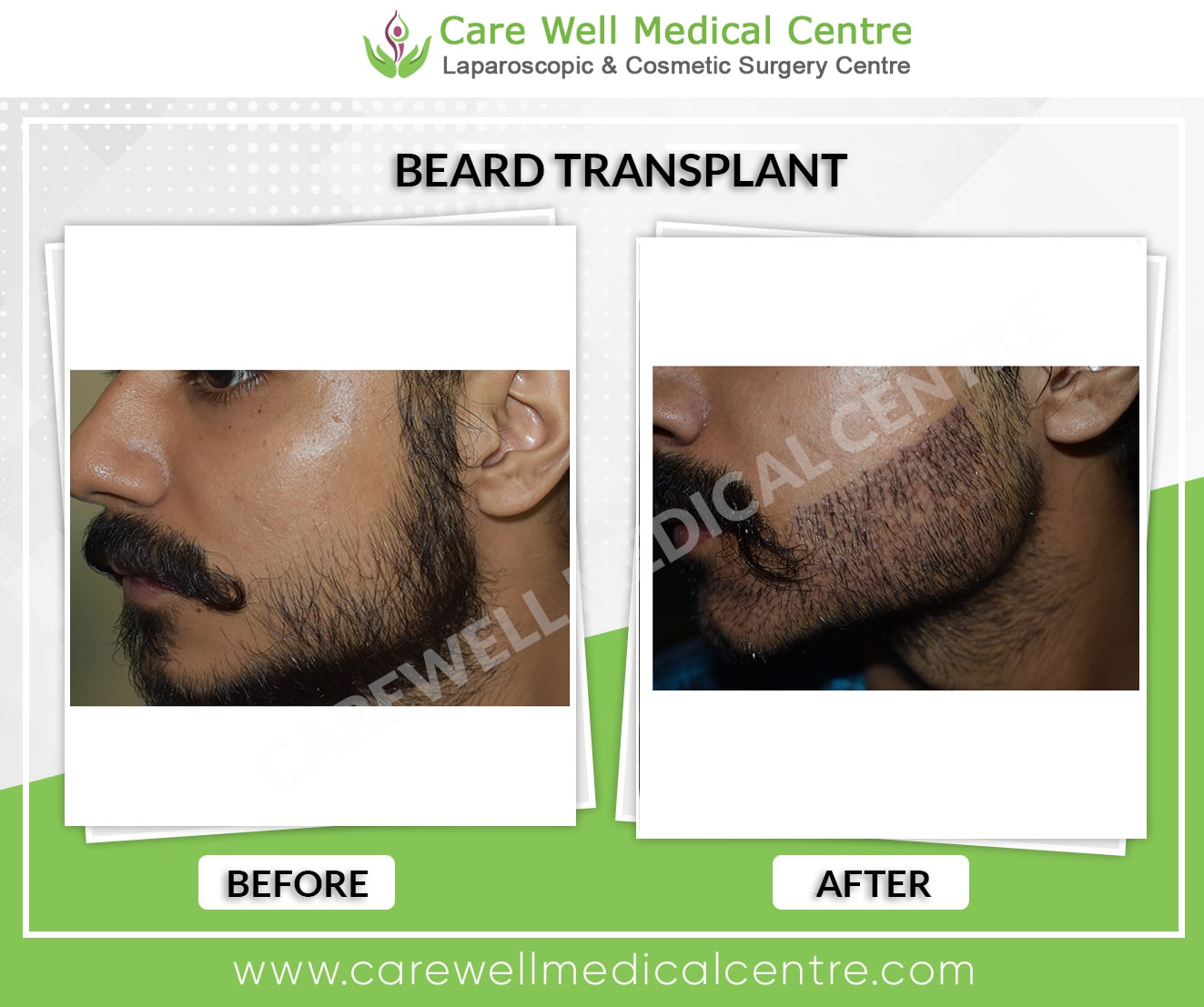 Transformative before and after results of a beard transplant in Delhi with natural growth.