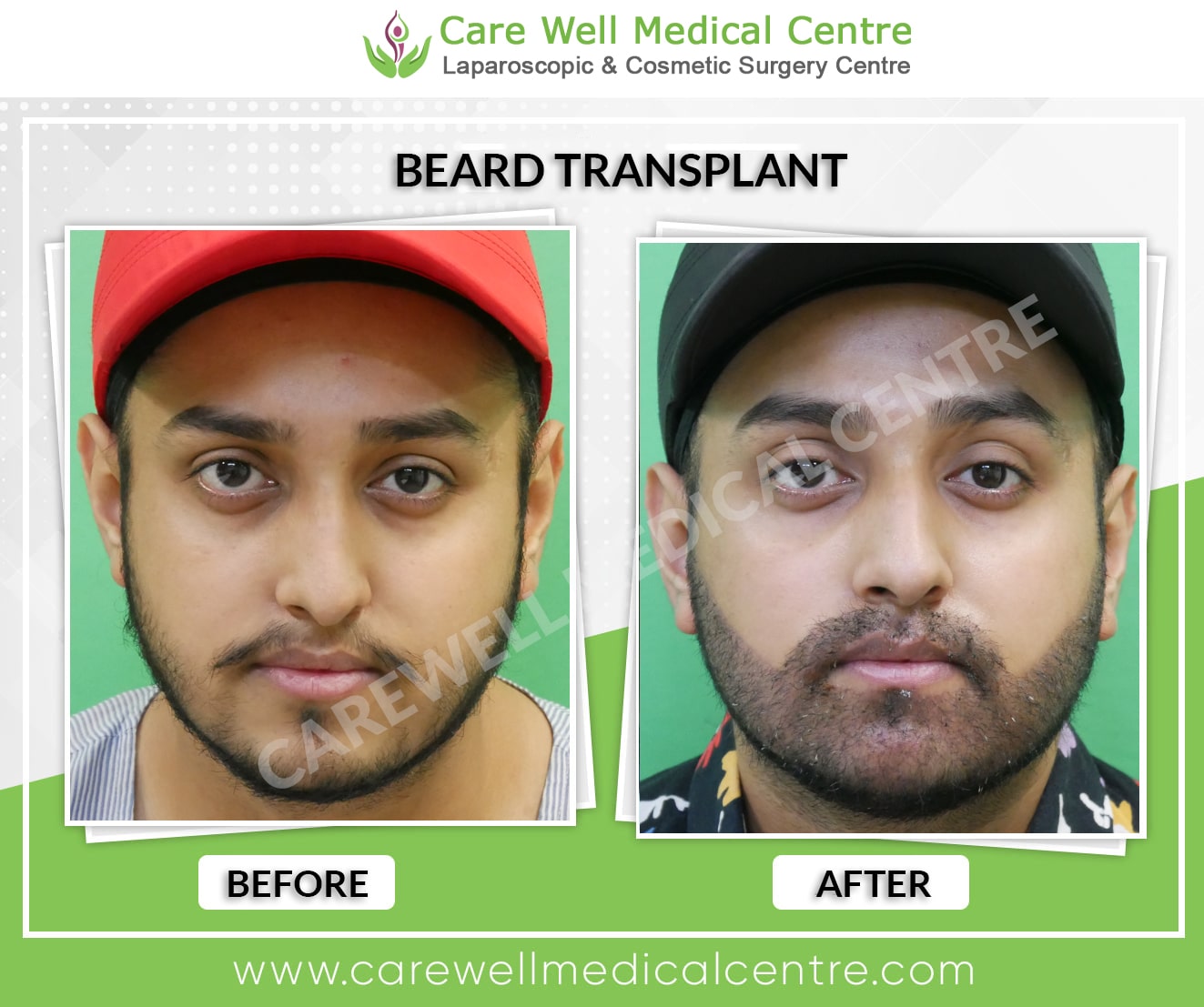 Before and after photos of a beard transplant in Delhi, showcasing natural and permanent results